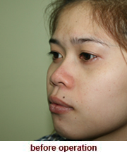 plastic_surgery_augmentation_rhinoplasty